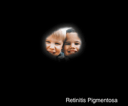 retinitis-pigmentosa-1